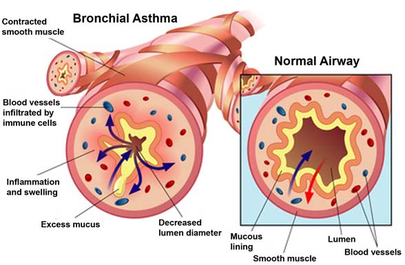 Asthma Affects The Respiratory System In Which Way ...