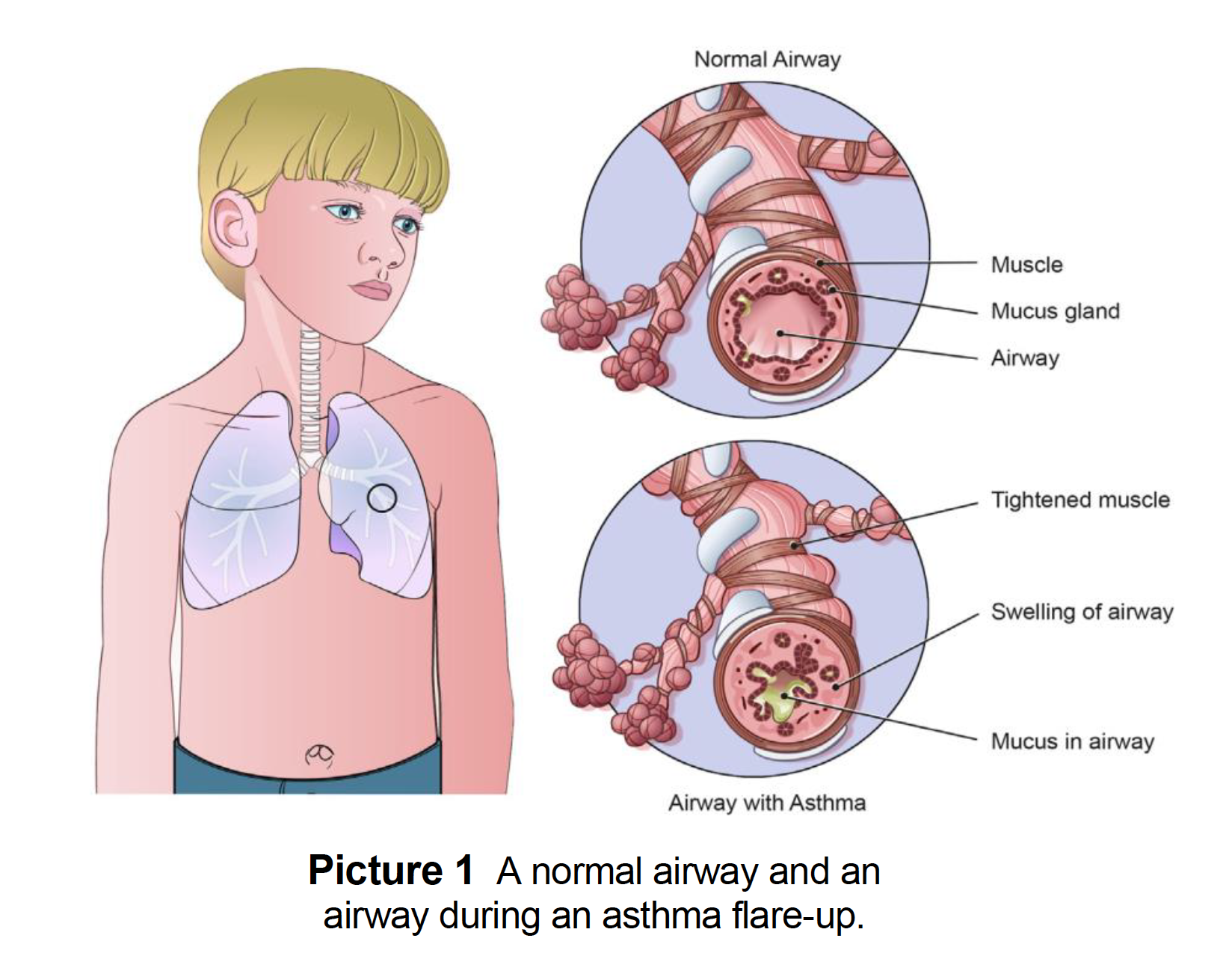 Asthma and Reactive Airway Disease (RAD) (Wheezing ...