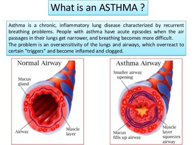 Asthma Characterized By