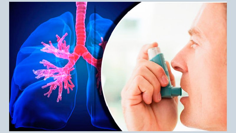 Asthma: Chronic respiratory disease