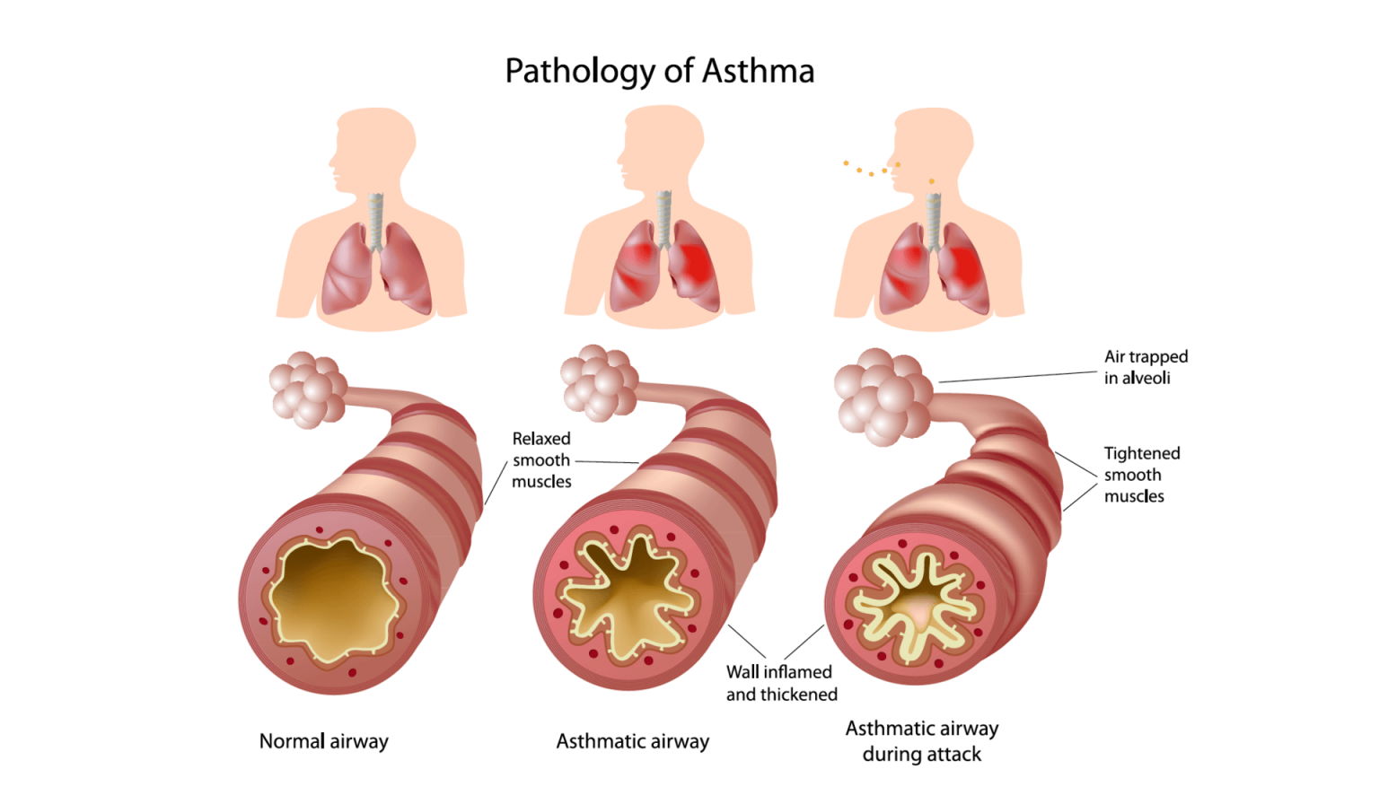 Asthma Cure