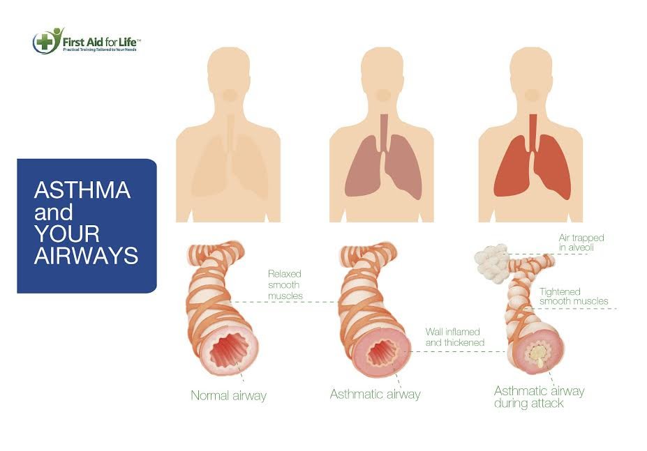 Asthma Due To Acid Reflux