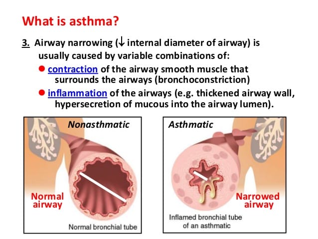 Asthma introduction Quiz Content slides 1