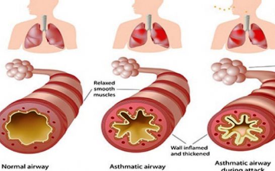 Asthma is a serious condition that can be dangerous when a ...