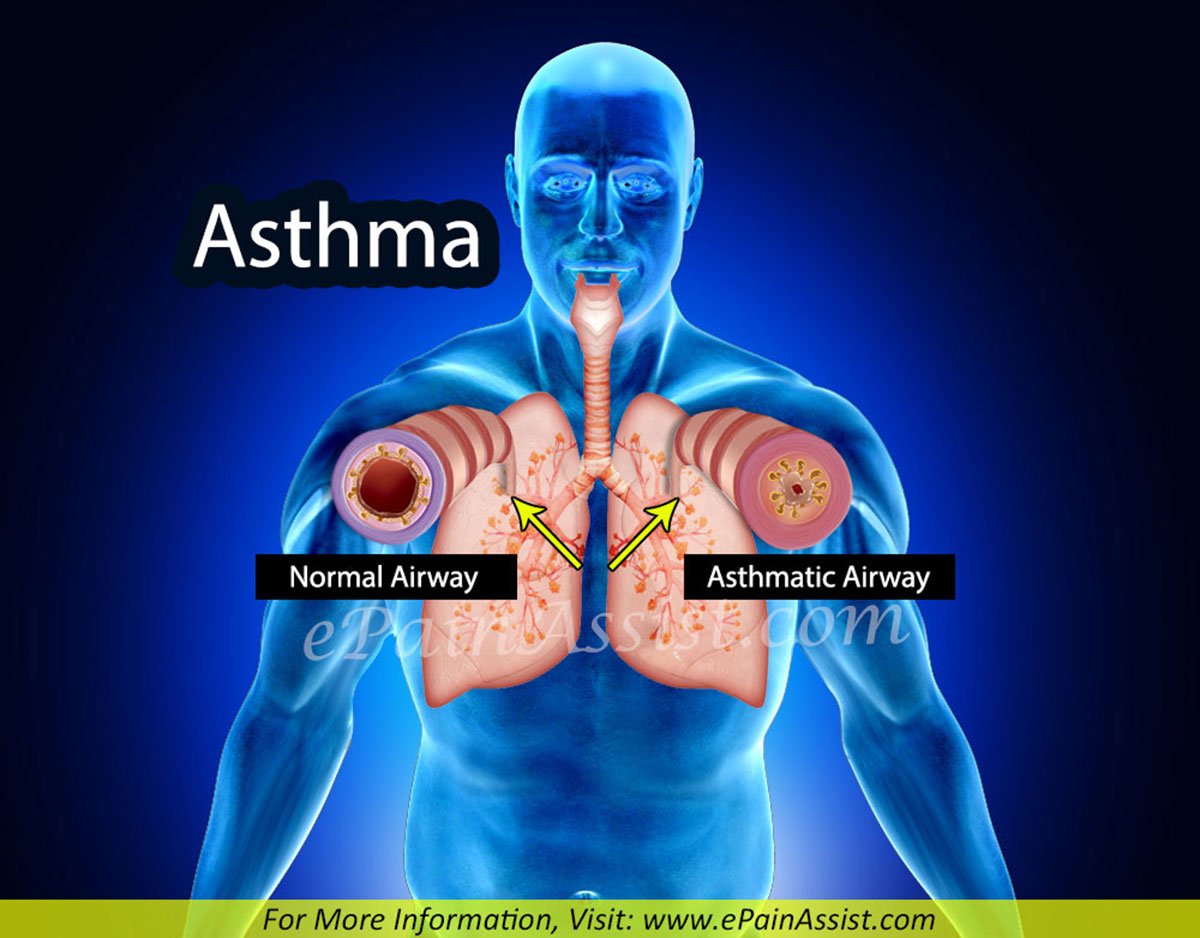 Asthma: Treatment, Home Remedies, Prevention, Symptoms