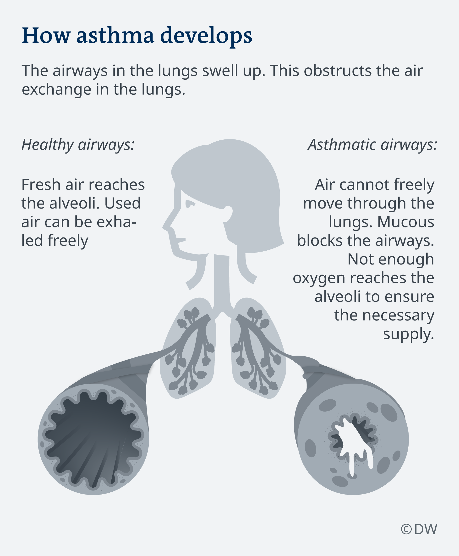 Asthma: When breathing becomes difficult