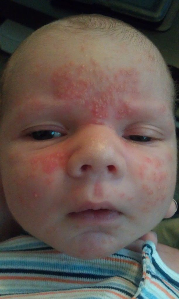 Bad baby acne? pics. Experiences??
