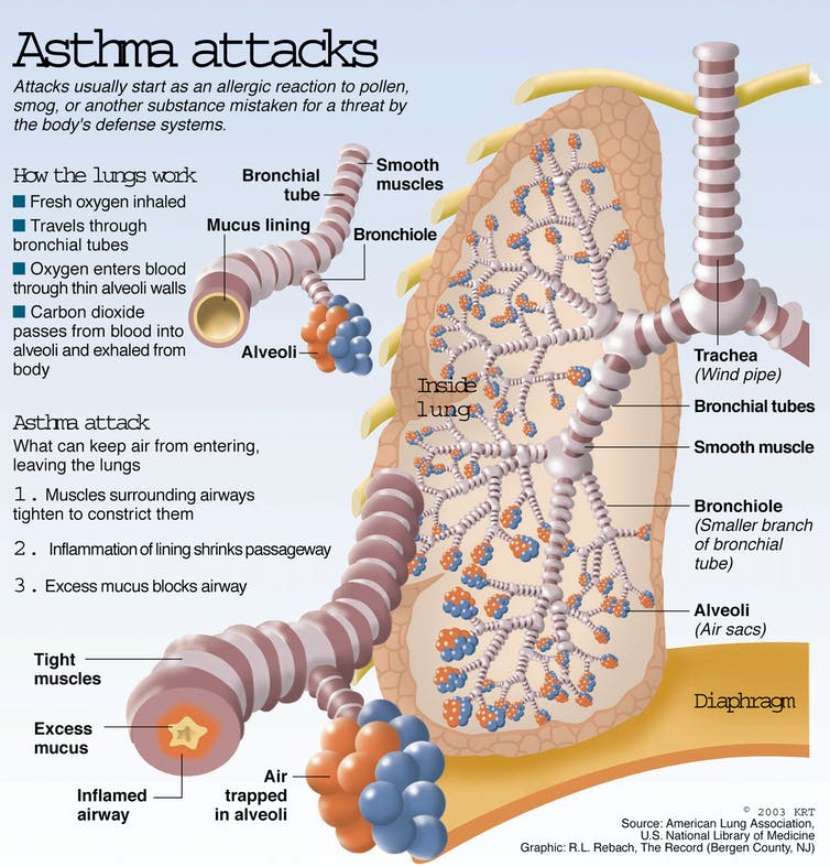 Breathe easy? Good and bad news about asthma