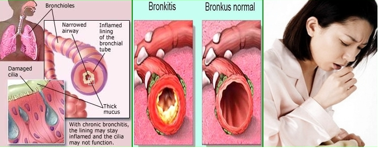 Bronchitis Homeopathy Treatment Clinic and Doctor in Ahmedabad