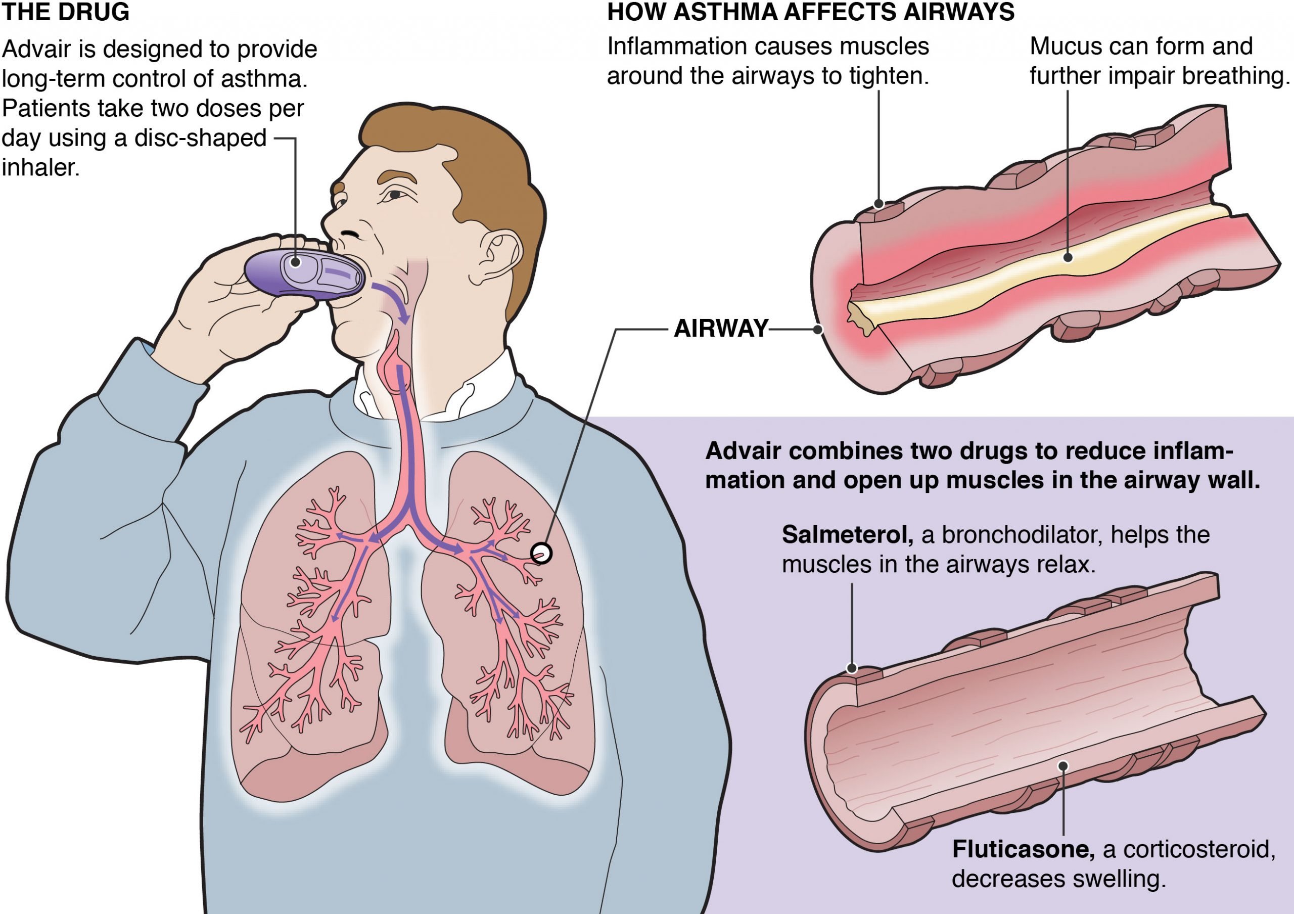 Can Asthma Cause Death