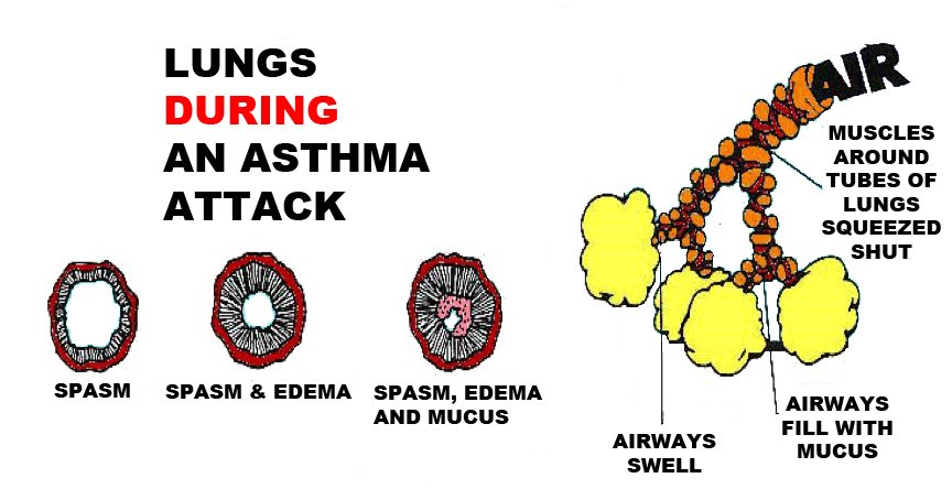 Can u be a firefighter with asthma  Health News