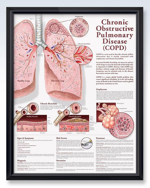 Chronic Obstructive Pulmonary Disease (COPD) Chart 20x26