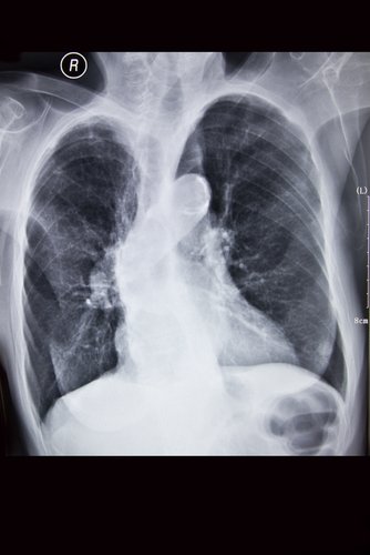 COPD and Bronchiectasis: Similarities and Differences ...