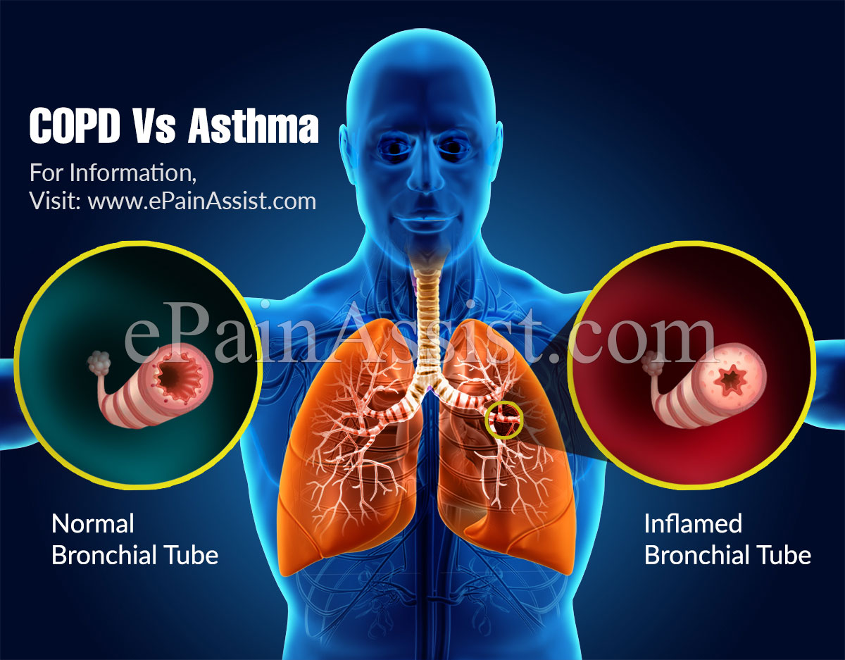 COPD Vs Asthma: Differences Worth Knowing