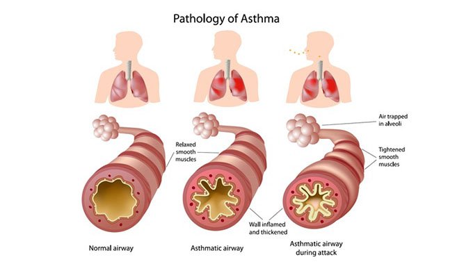 Dealing with asthma attacks