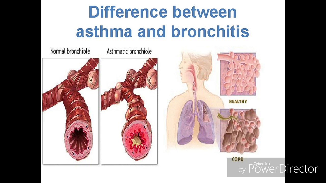 difference between asthma and bronchitisHD 1