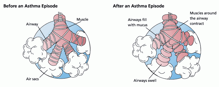 Difference between asthma and emphysema