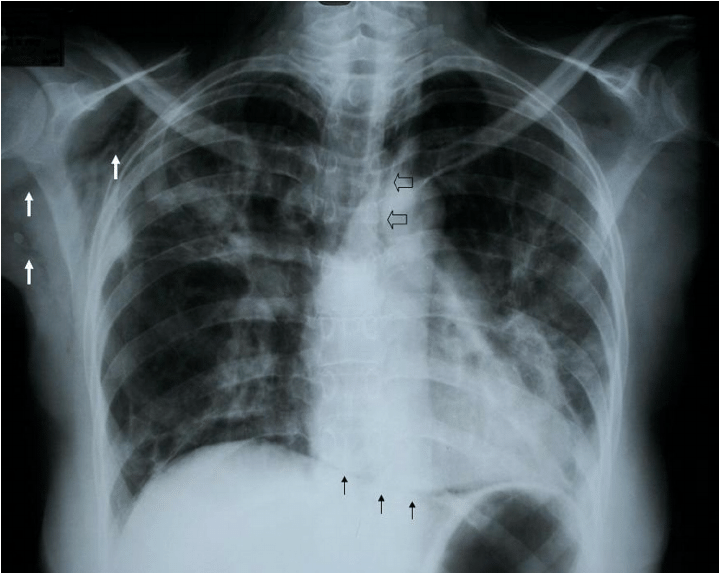 Does Interstitial Lung Disease Show Up On Xray