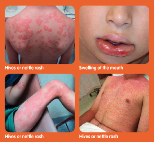 Example Symptoms of Anaphylaxis