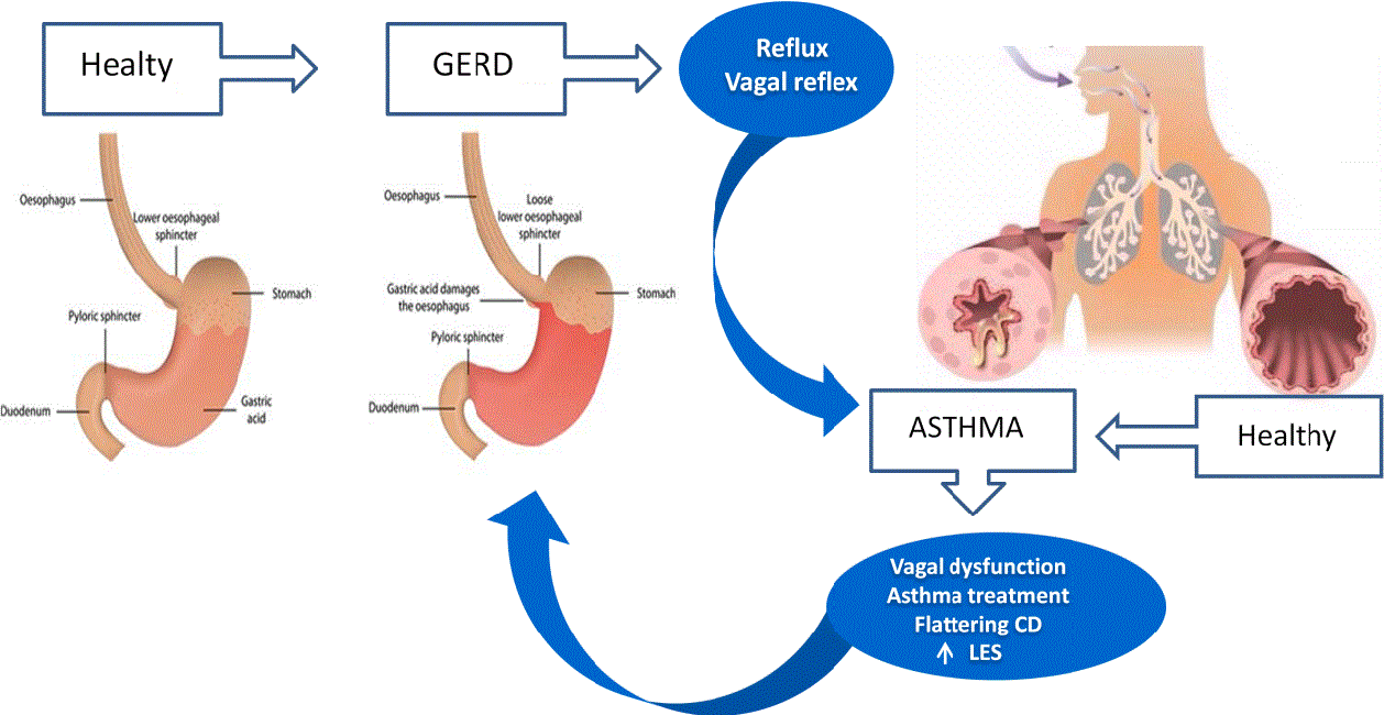 Gastroesophageal Reflux Disease and Airway ...
