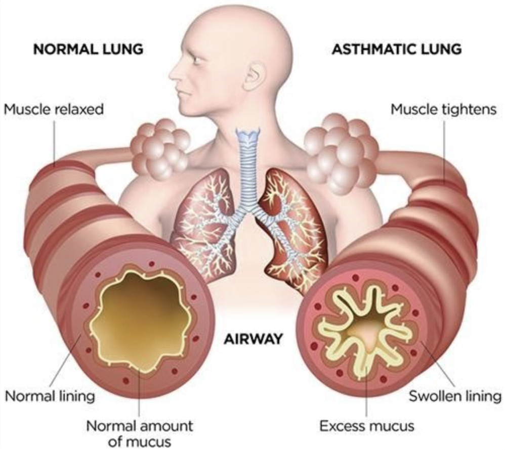 Hijama Points For Asthma And Breathing Difficulties.