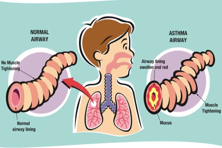 How Do You Get Asthma? Things You Must Know