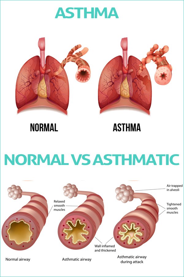 How to Cure Asthma: Causes, Symptoms, Treatment