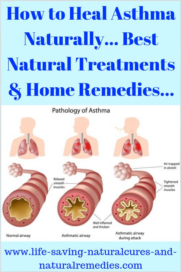 How to heal asthma naturally &  quickly... 10 best natural ...
