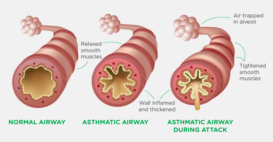 How to Treat Asthma Attacks in Kids