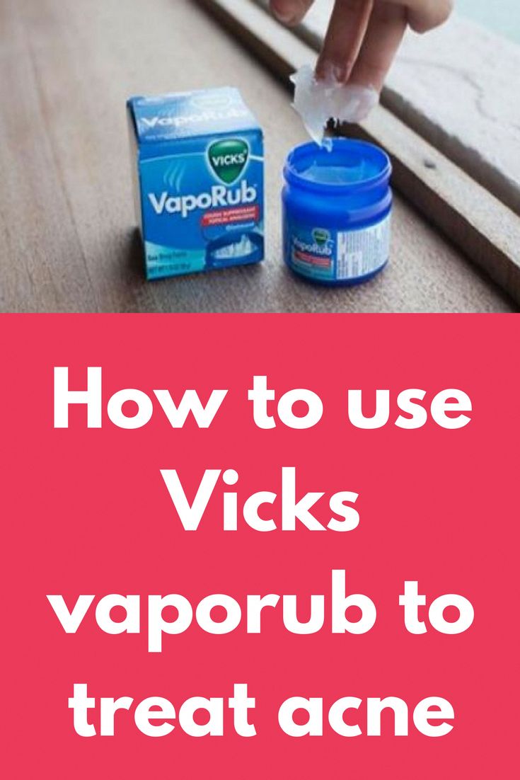 How to use Vicks vaporub to treat acne I have earlier told ...
