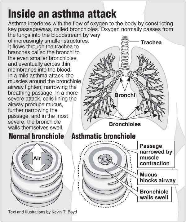 Information graphic about asthma attacks from PointFinder.org. Enjoy ...