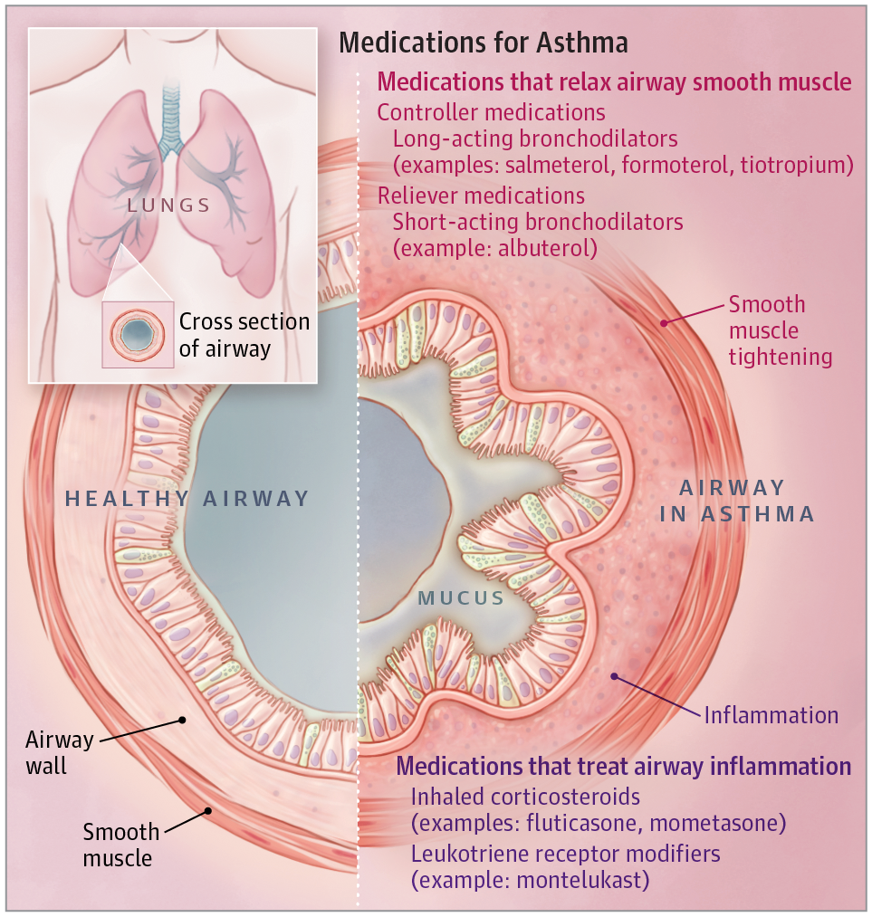 Medications for Asthma
