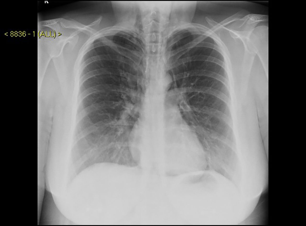 Severe chest pain in an asthmatic patient