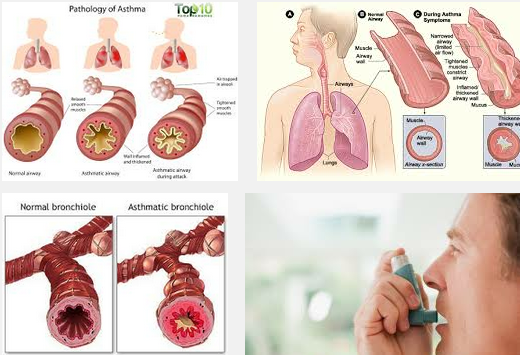 Symptoms of Asthma Attack In children