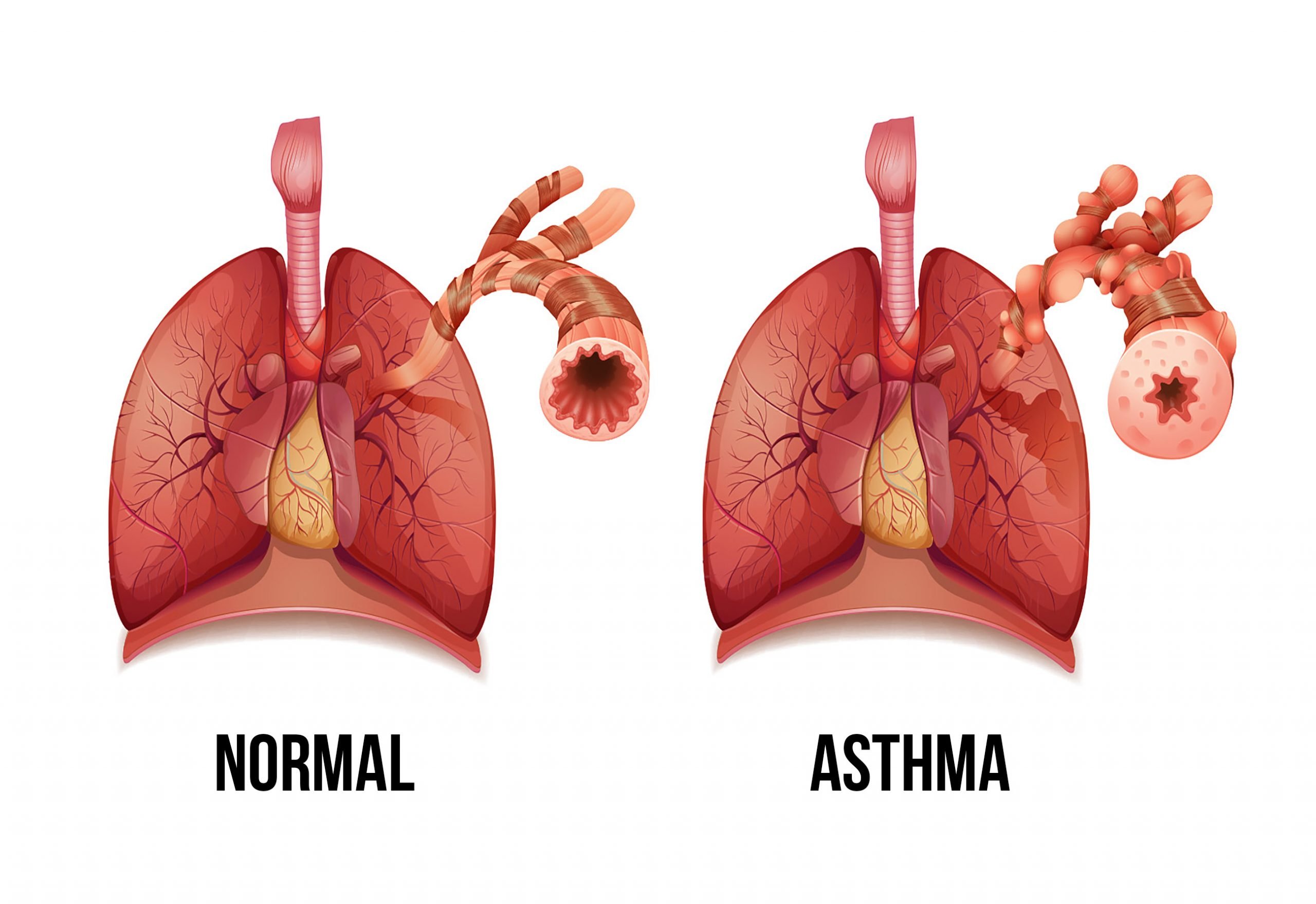 Top 6 benefits of cannabis for asthma