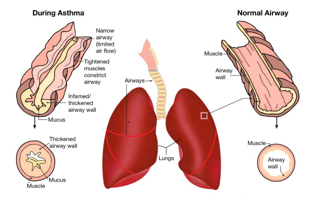 Traditional Remedy for Asthma, Bronchitis, Cough &  Lung ...