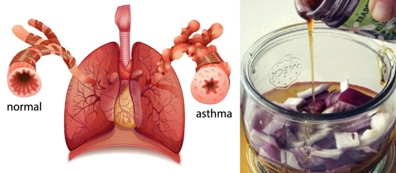 Tried and Tested Remedy That Can Treat Chronic Lung ...