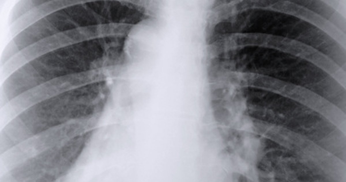 What Does Aspiration Mean in Connection With Your Lungs ...