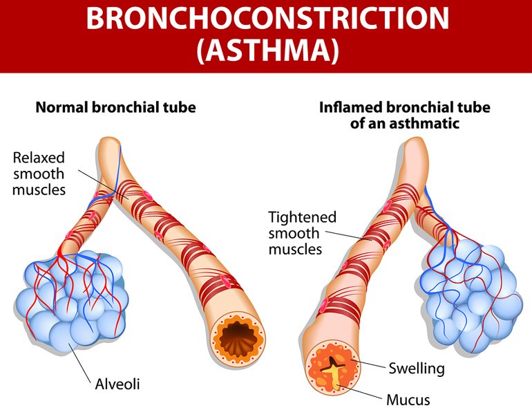 What is Asthma? :: Being Well