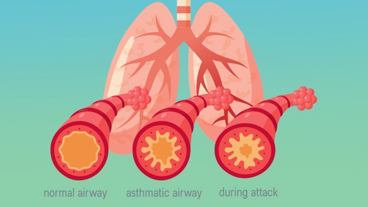 What Is Asthma? Symptoms, Causes, Diagnosis, Treatment ...